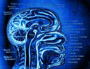 Brain lesions and migraine