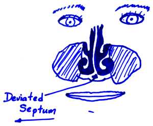 Deviated septum